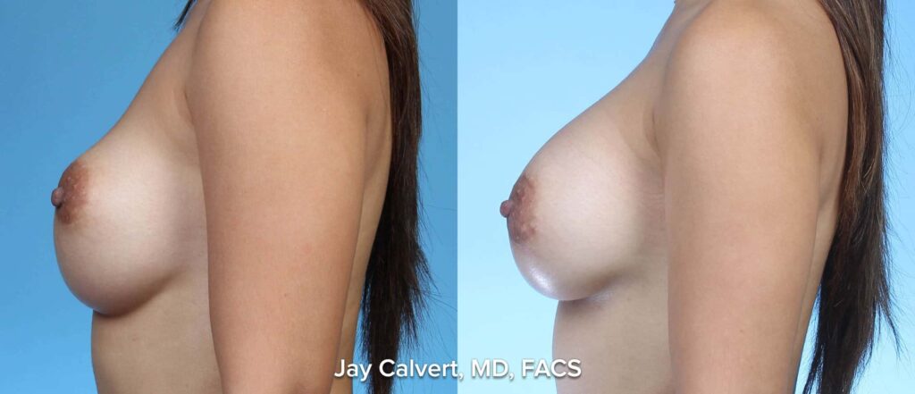 breast augmentation before and afters