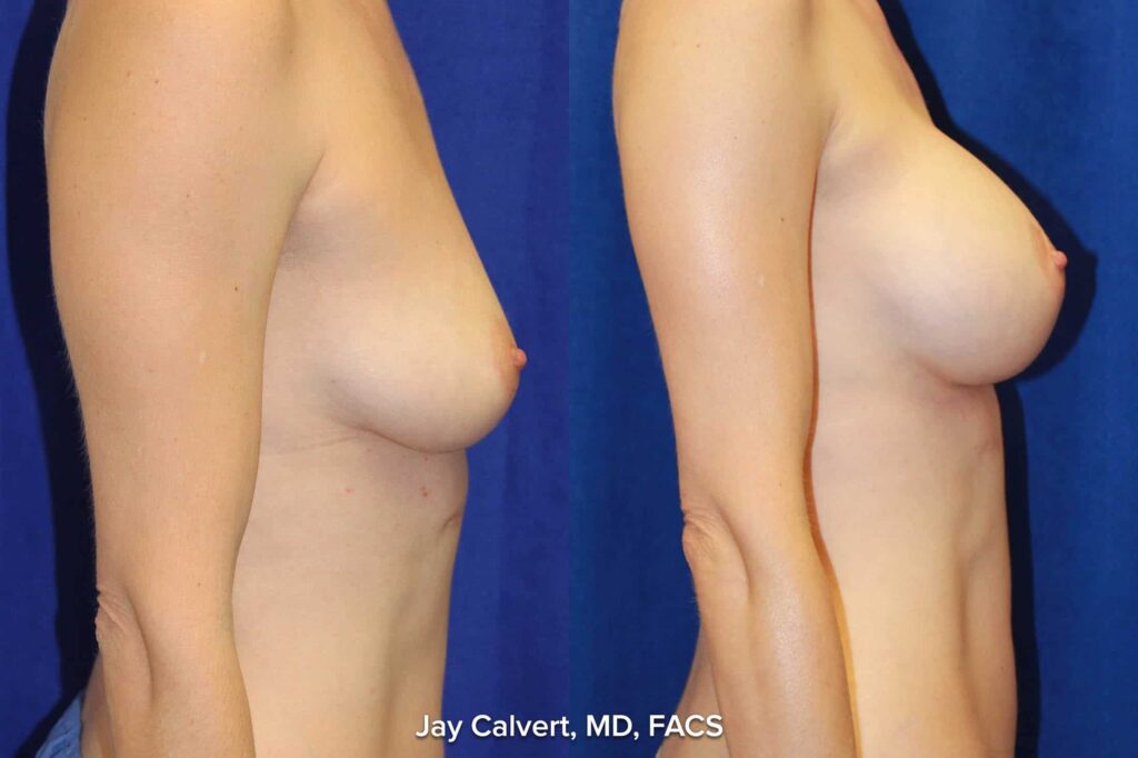 best breast implants results
