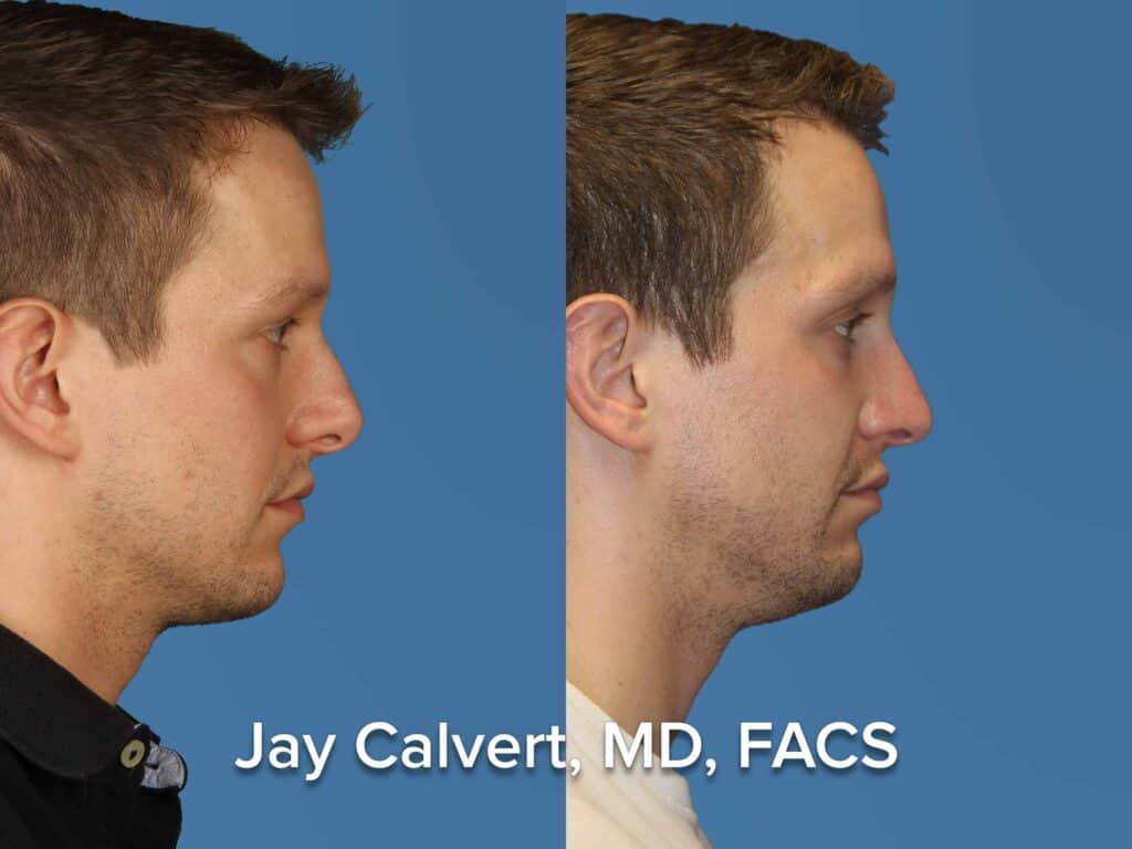 Male Revision Rhinoplasty Side View Photo