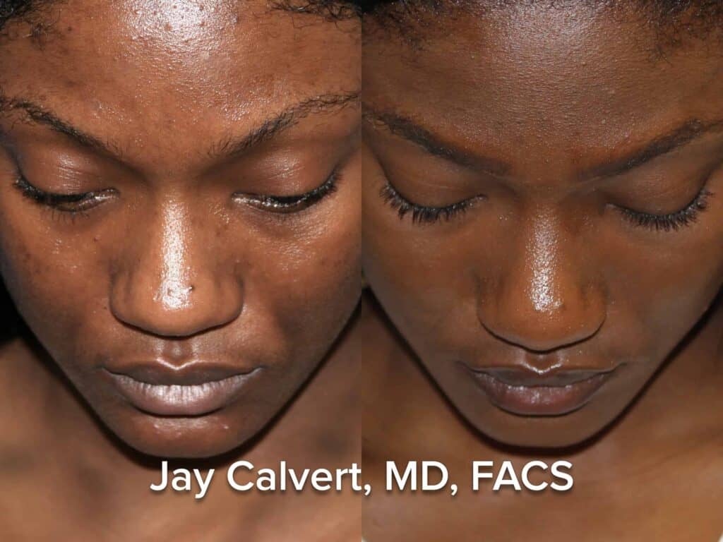 african american rhinoplasty before and after