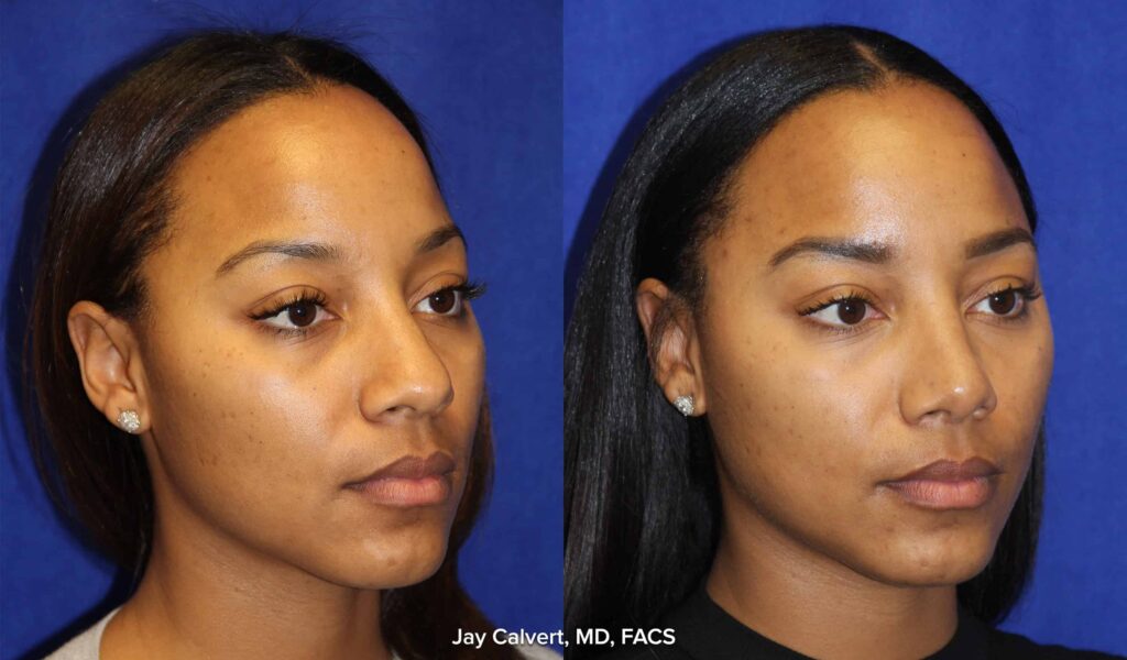 Oblique view before and after of African American Rhinoplasty patient by Dr Jay Calvert
