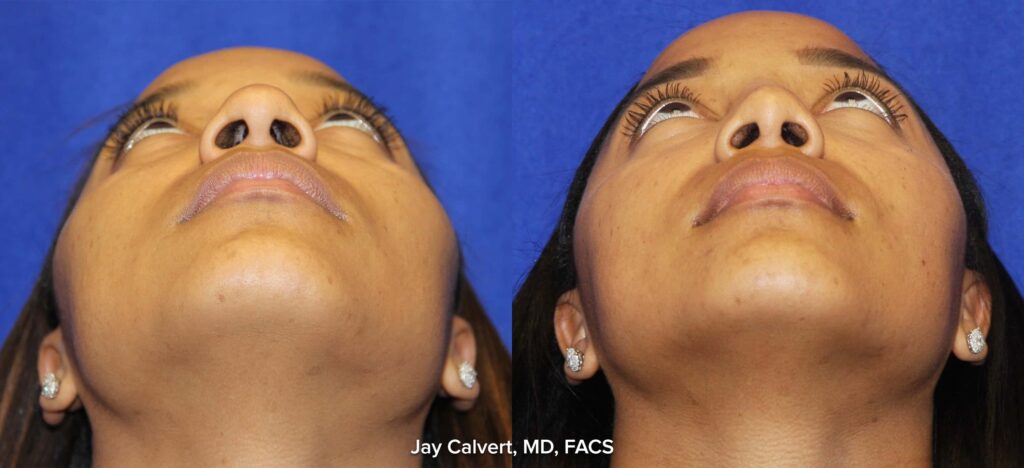 Base view of primary Rhinoplasty patient of African American descent