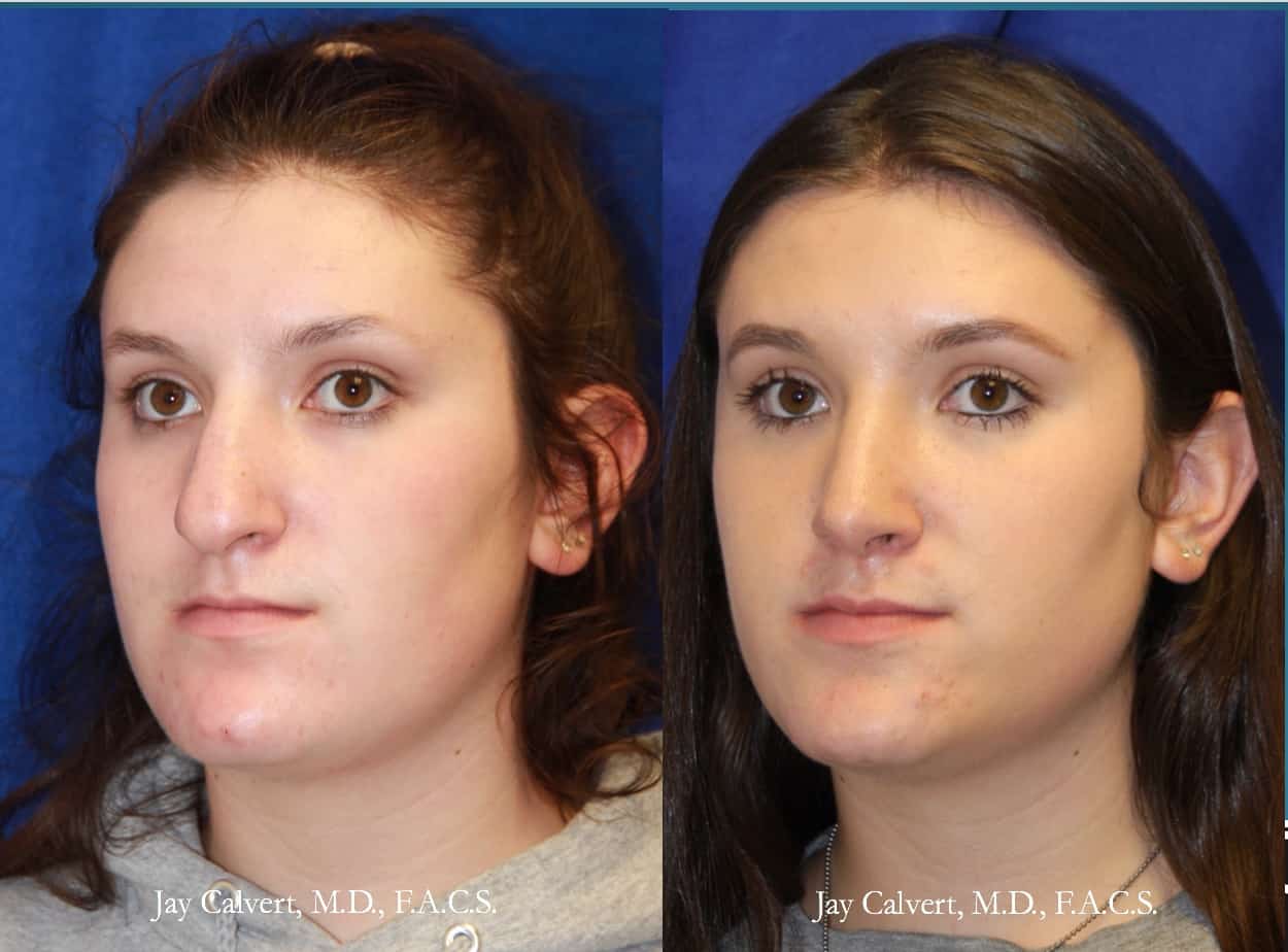 Rhinoplasty Beverly Hills before and afters