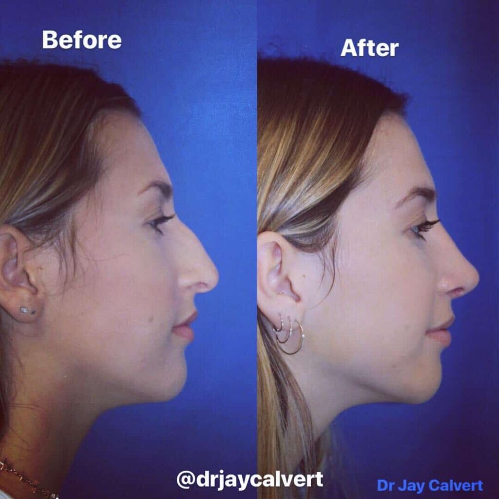 Your Rhinoplasty Questions Dr. Jay Calvert