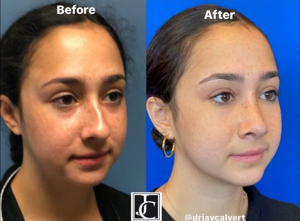 Teen Rhinoplasty Beverly Hills - Dr Jay Calvert