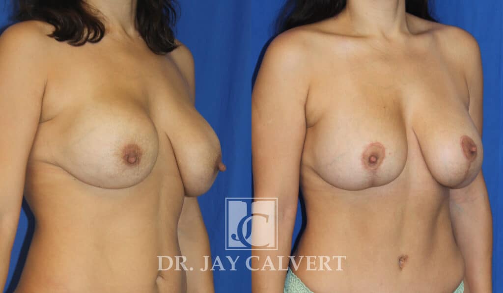 breast implant exchange patient before and after