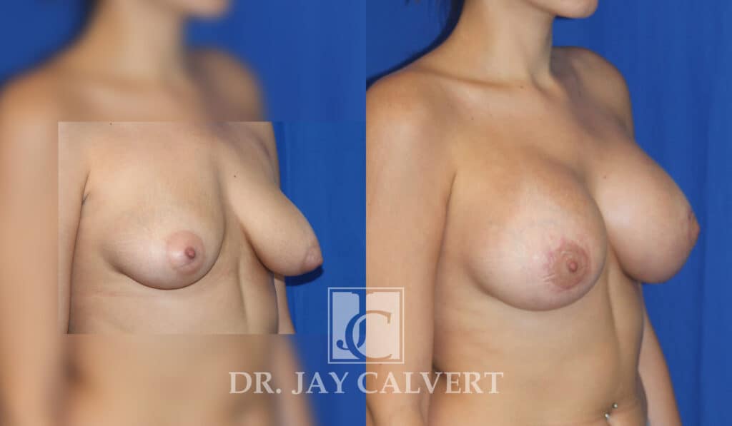breast augmentation before and after patient