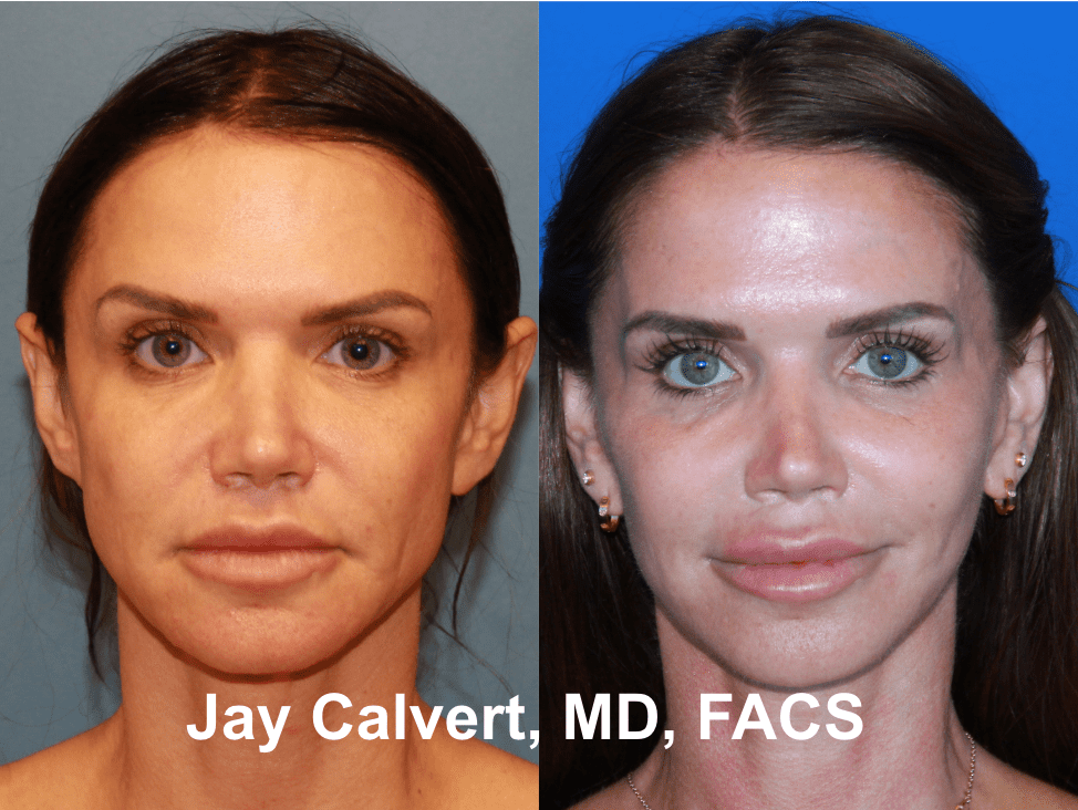 Facelift by Dr. Jay Calvert 1-3