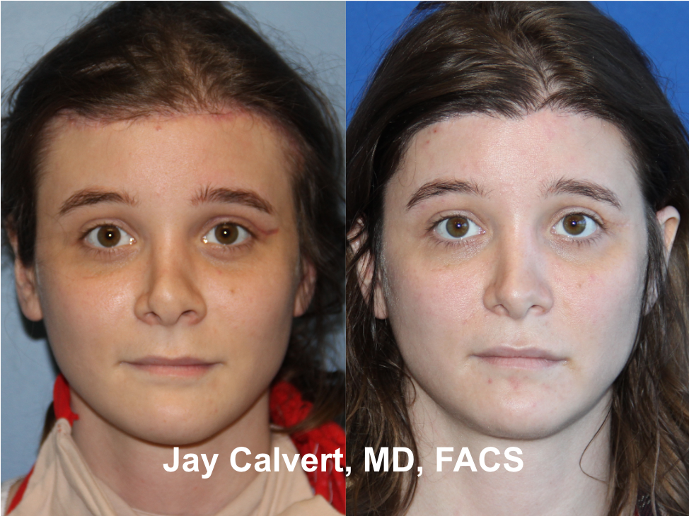 Revision Rhinoplasty With Rib by Dr. Jay Calvert 1-a