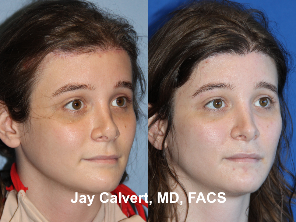 Revision Rhinoplasty With Rib by Dr. Jay Calvert 1-c