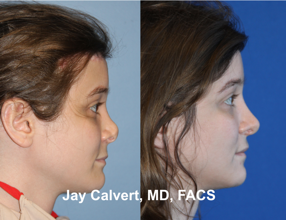 Revision Rhinoplasty With Rib by Dr. Jay Calvert 1-d