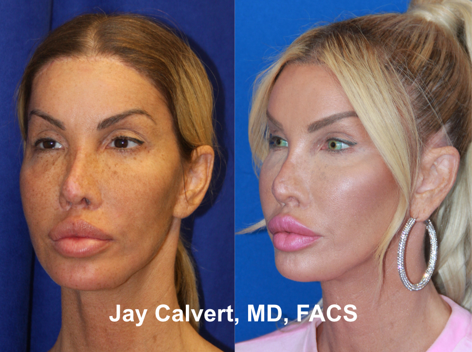 Revision Rhinoplasty With Rib by Dr. Jay Calvert 1c