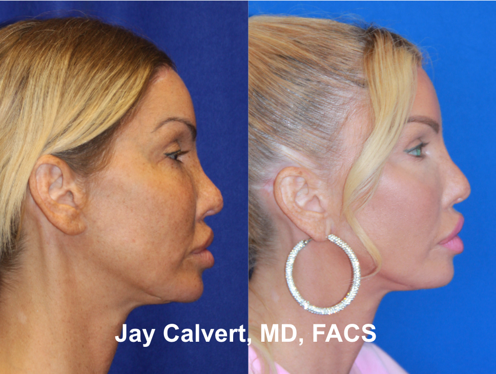 Revision Rhinoplasty With Rib by Dr. Jay Calvert 1d