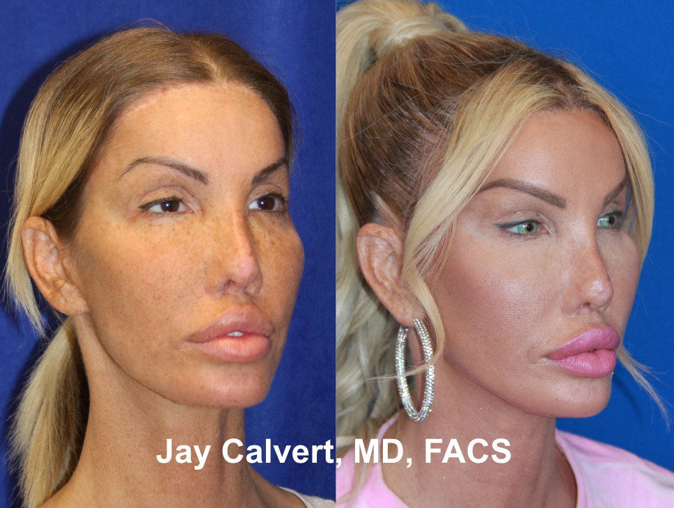 Revision Rhinoplasty With Rib by Dr. Jay Calvert 1e