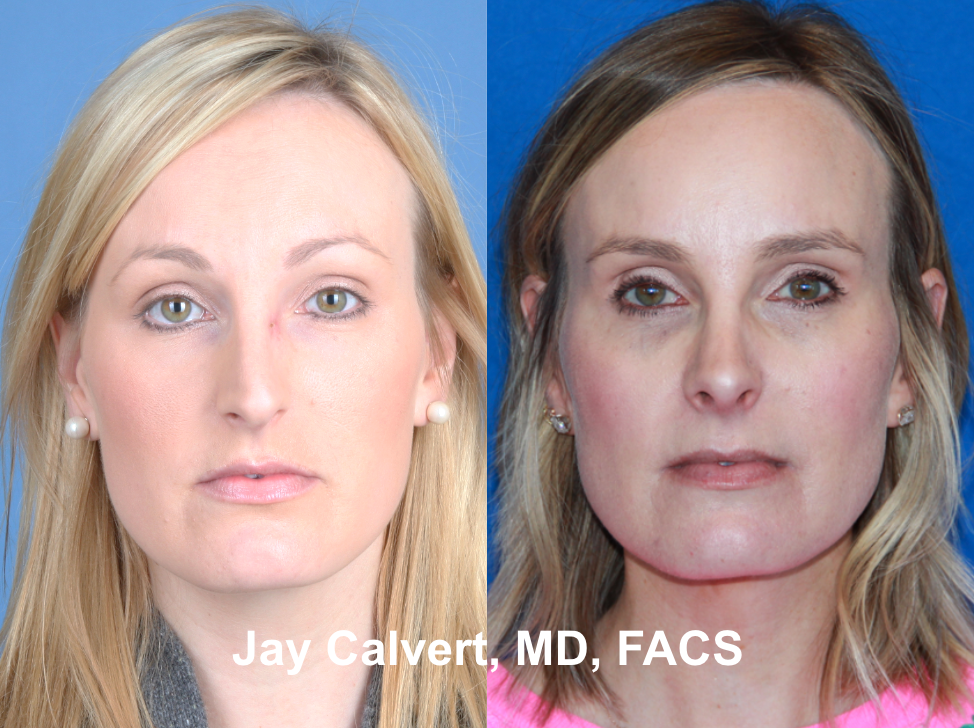Revision Rhinoplasty by Dr. Jay Calvert t1