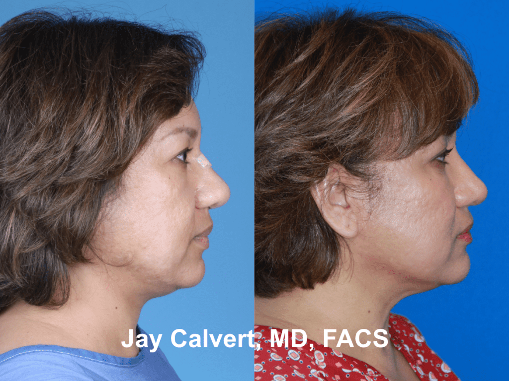 Revision Rhinoplasty by Dr. Jay Calvert h