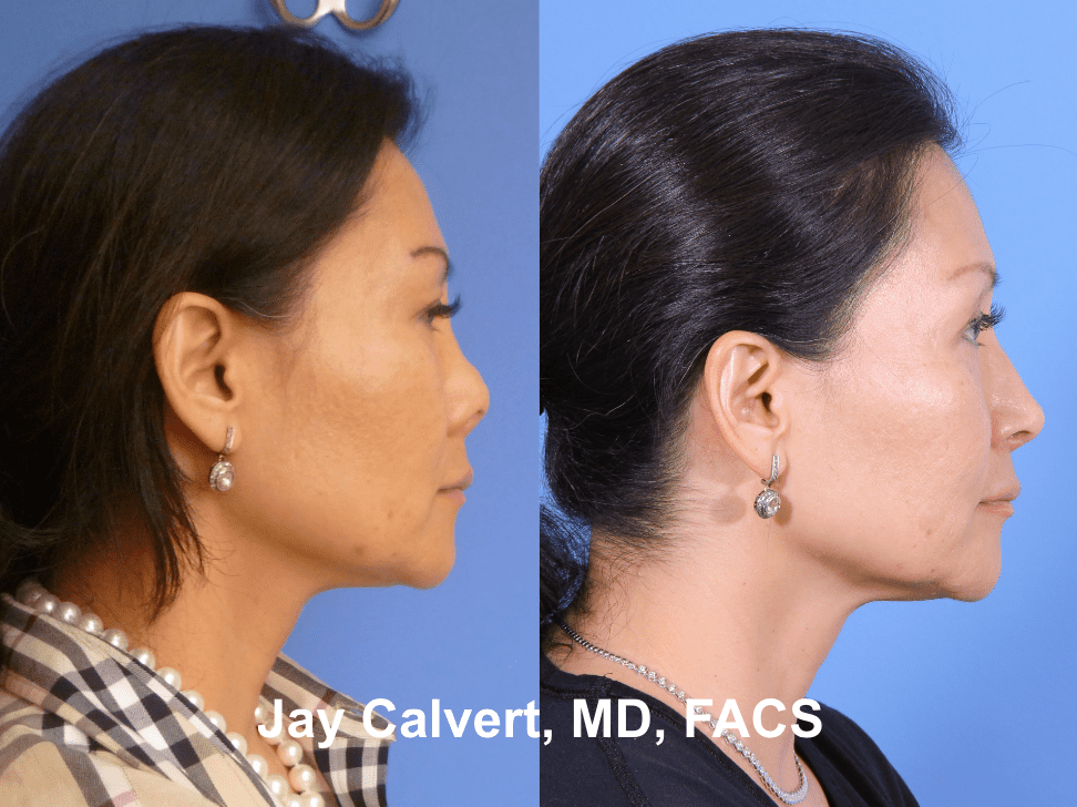 Revision Rhinoplasty by Dr. Jay Calvert 4e