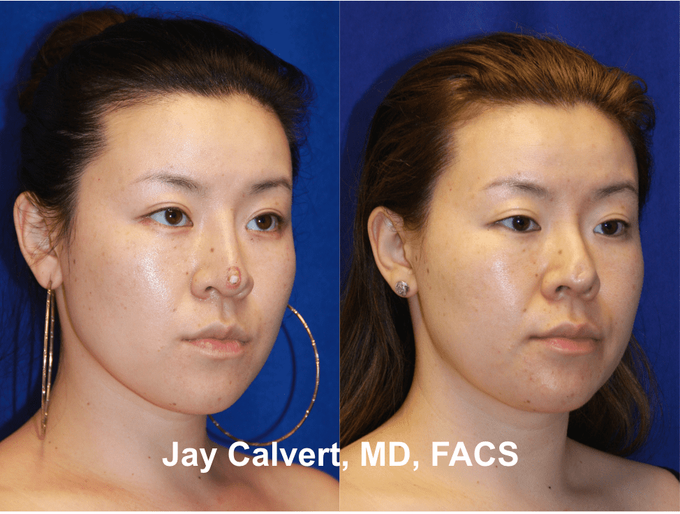 Revision Rhinoplasty by Dr. Jay Calvert 4a