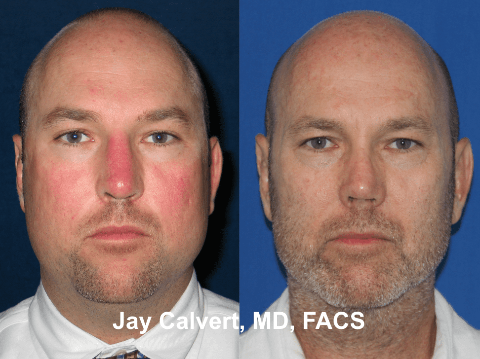 Revision Rhinoplasty by Dr. Jay Calvert 2d