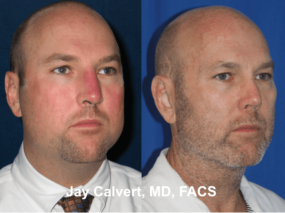 Revision Rhinoplasty by Dr. Jay Calvert 2c