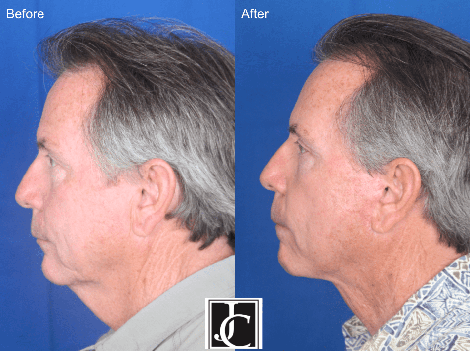 Male facelift performed by Dr Jay Calvert