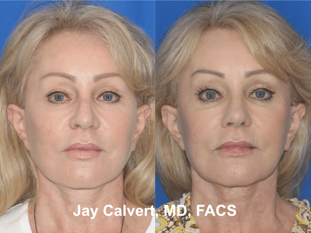 Facial Rejuvenation by Dr. Jay Calvert a4