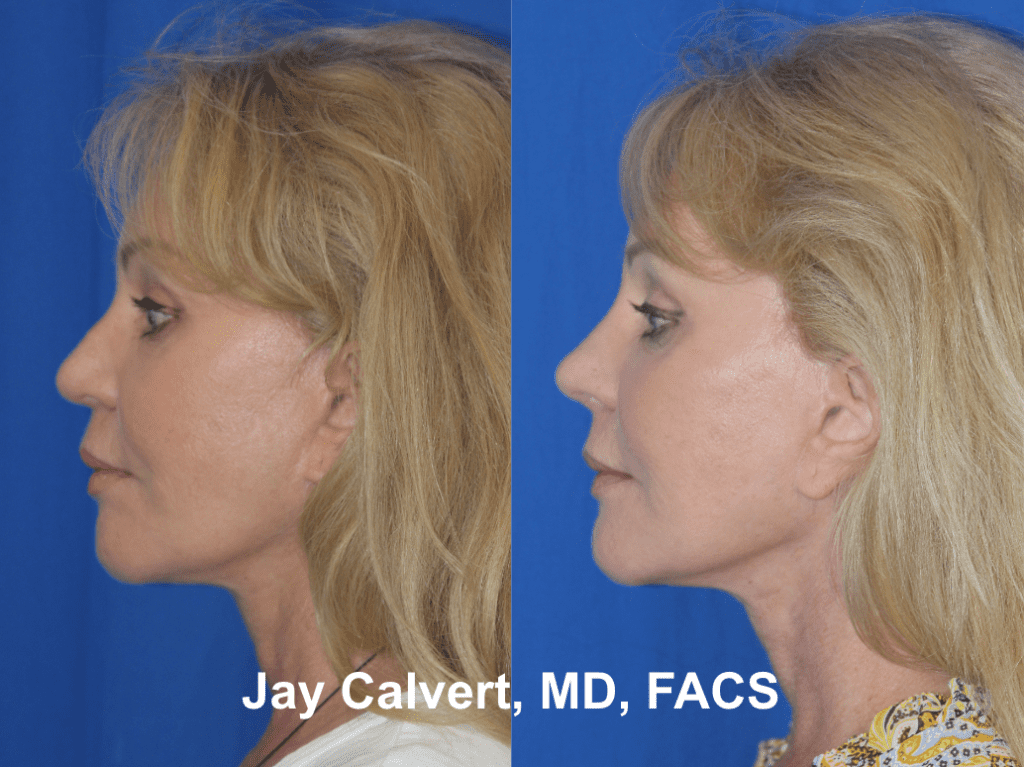Facial Rejuvenation by Dr. Jay Calvert a1