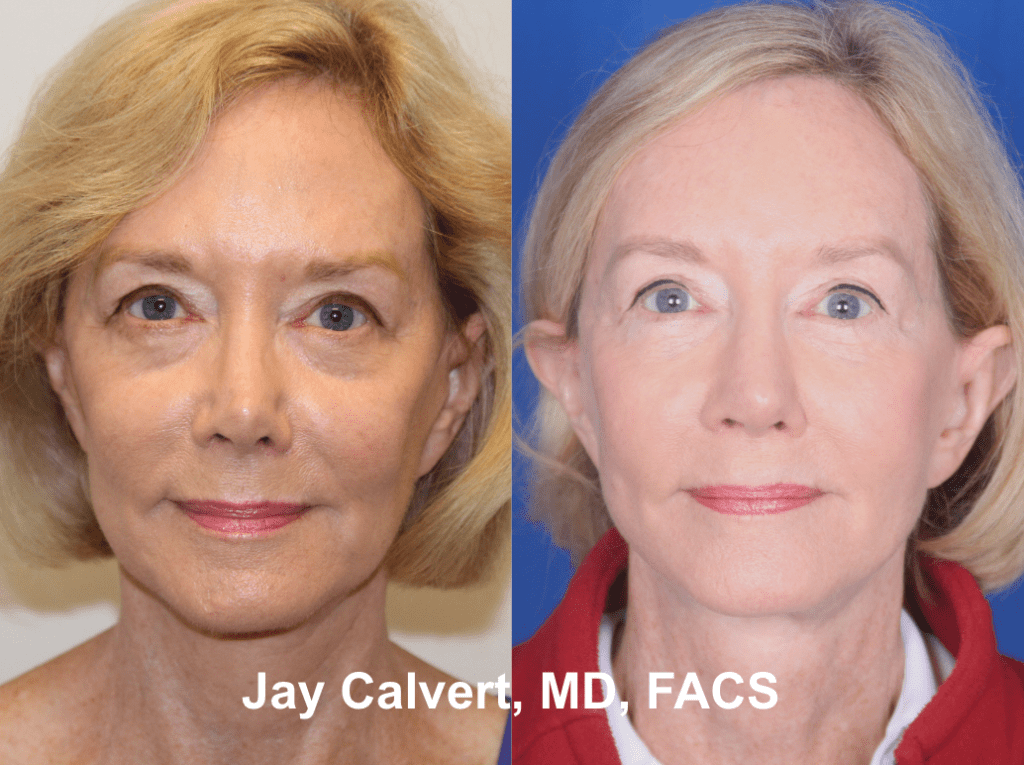 Facial Surgeries by Dr. Jay Calvert 1d