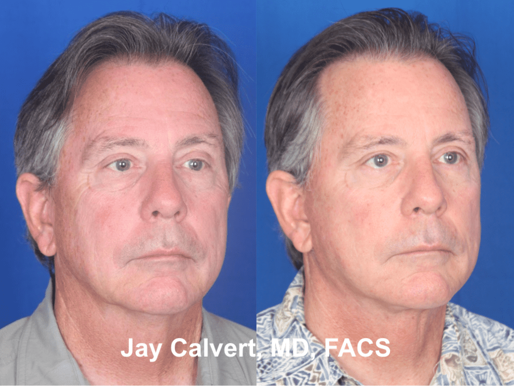 Male facelift by Dr. Jay Calvert 1b