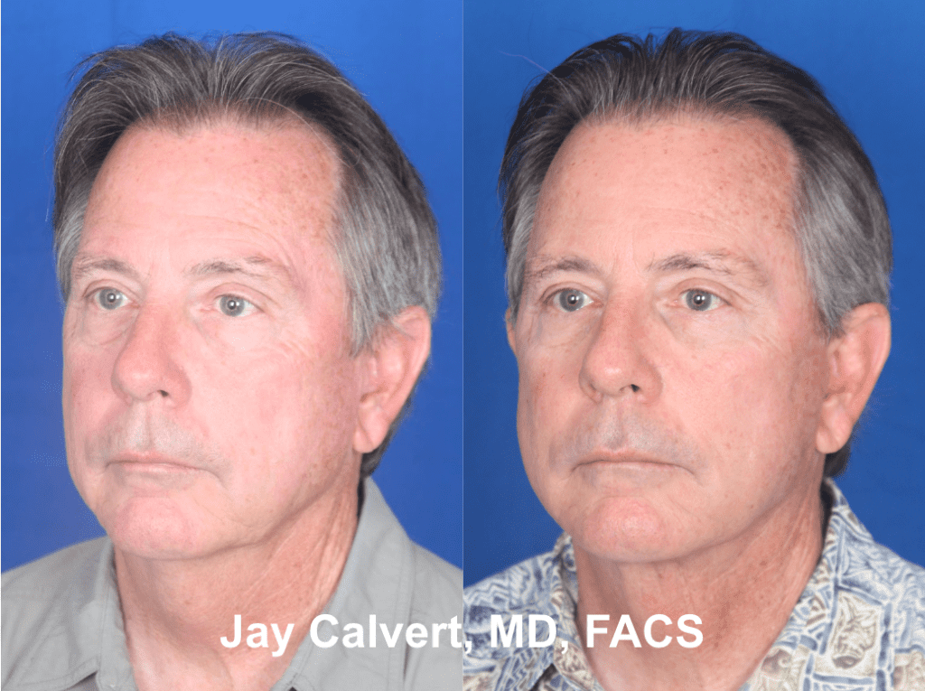 Male facelift by Dr. Jay Calvert 1a