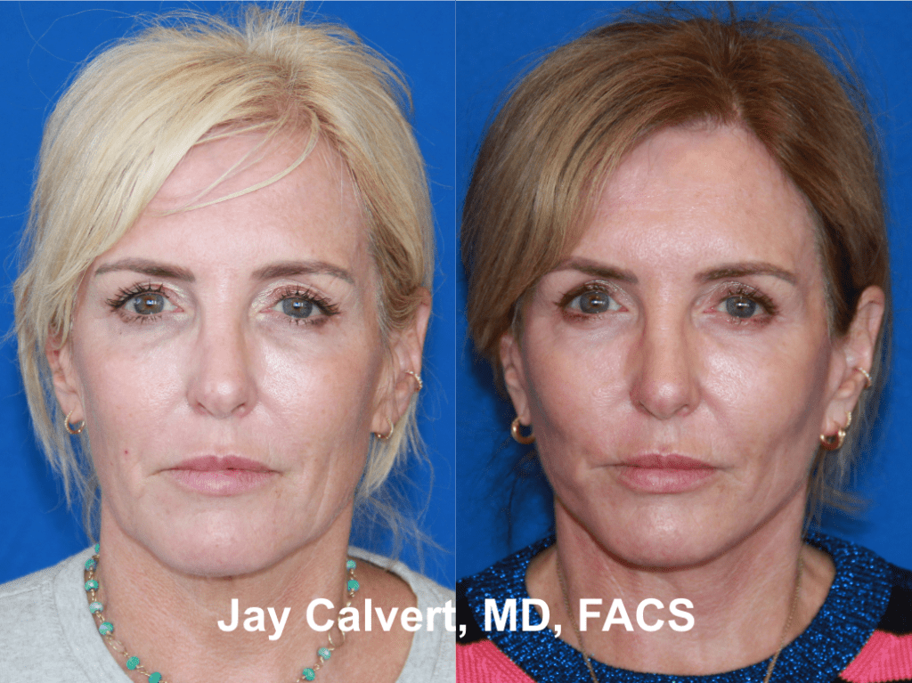 Facial Rejuvenation by Dr. Jay Calvert b4
