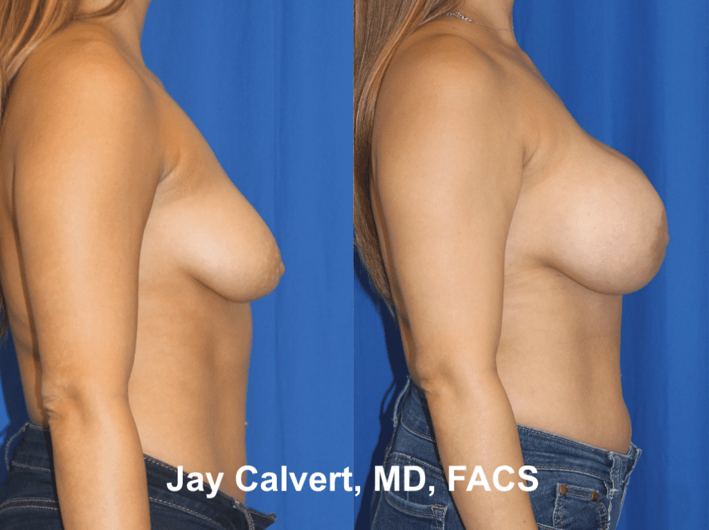 Primary Breast Augmentation by Dr. Jay Calvert a3