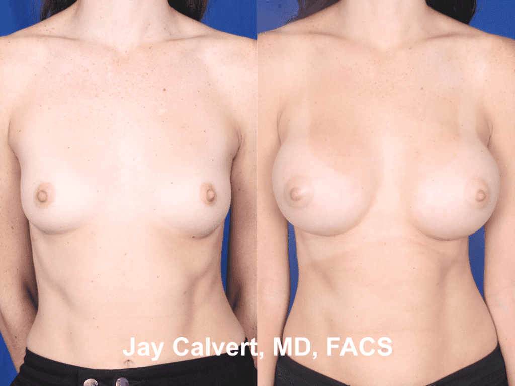 Primary Breast Augmentation by Dr. Jay Calvert ad