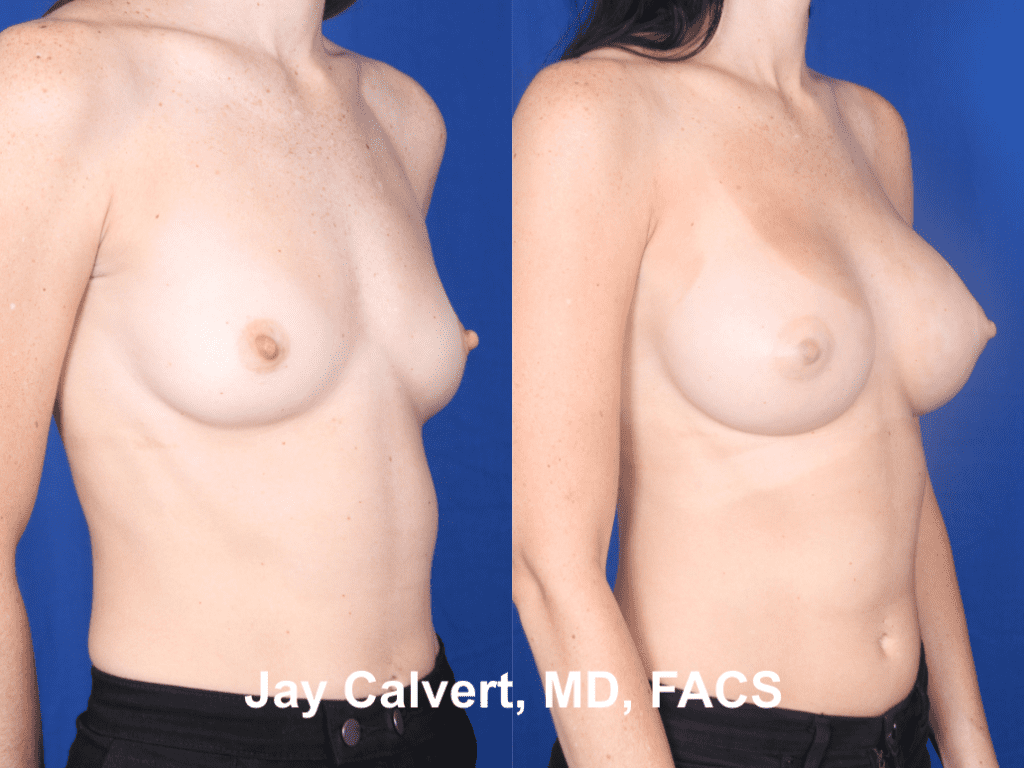 Primary Breast Augmentation by Dr. Jay Calvert ac