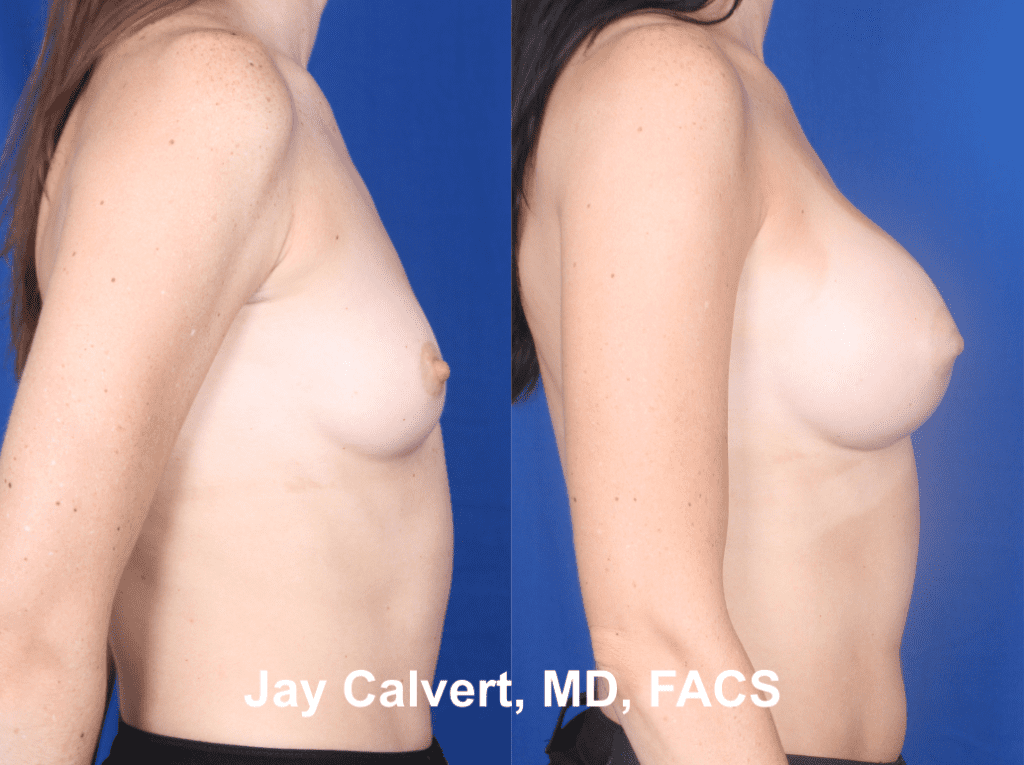 Primary Breast Augmentation by Dr. Jay Calvert ac