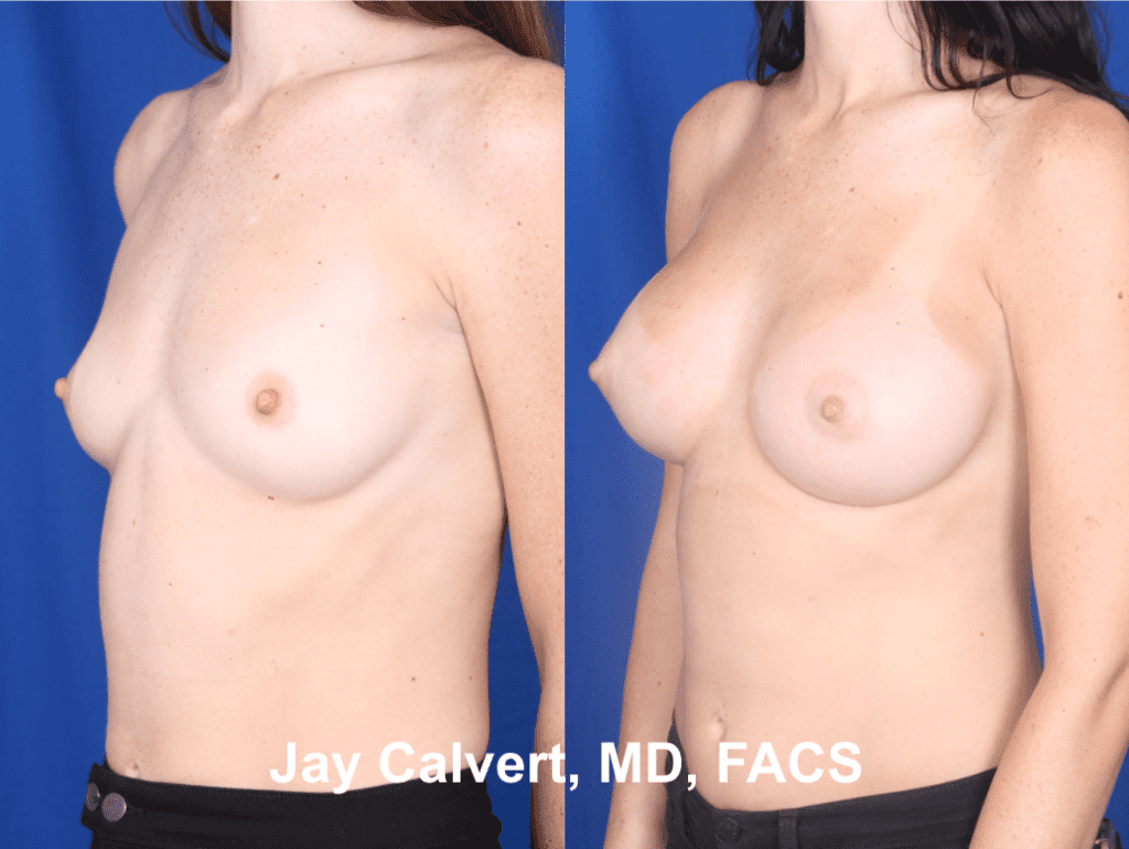 Primary Breast Augmentation by Dr. Jay Calvert ab