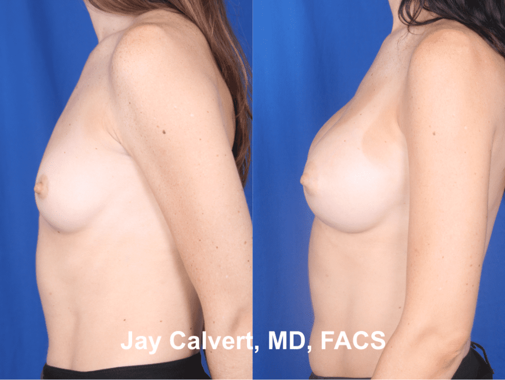 Primary Breast Augmentation by Dr. Jay Calvert aa