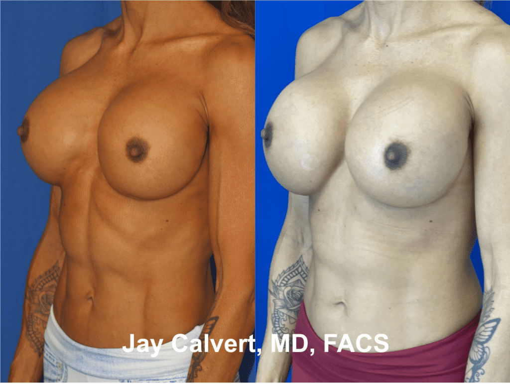 Breast Implant R&R by Dr. Jay Calvert 1d