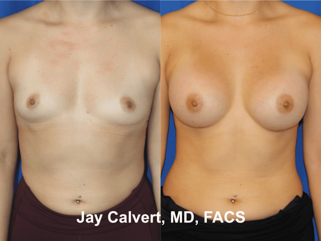 Primary Breast Augmentation by Dr. Jay Calvert 8e