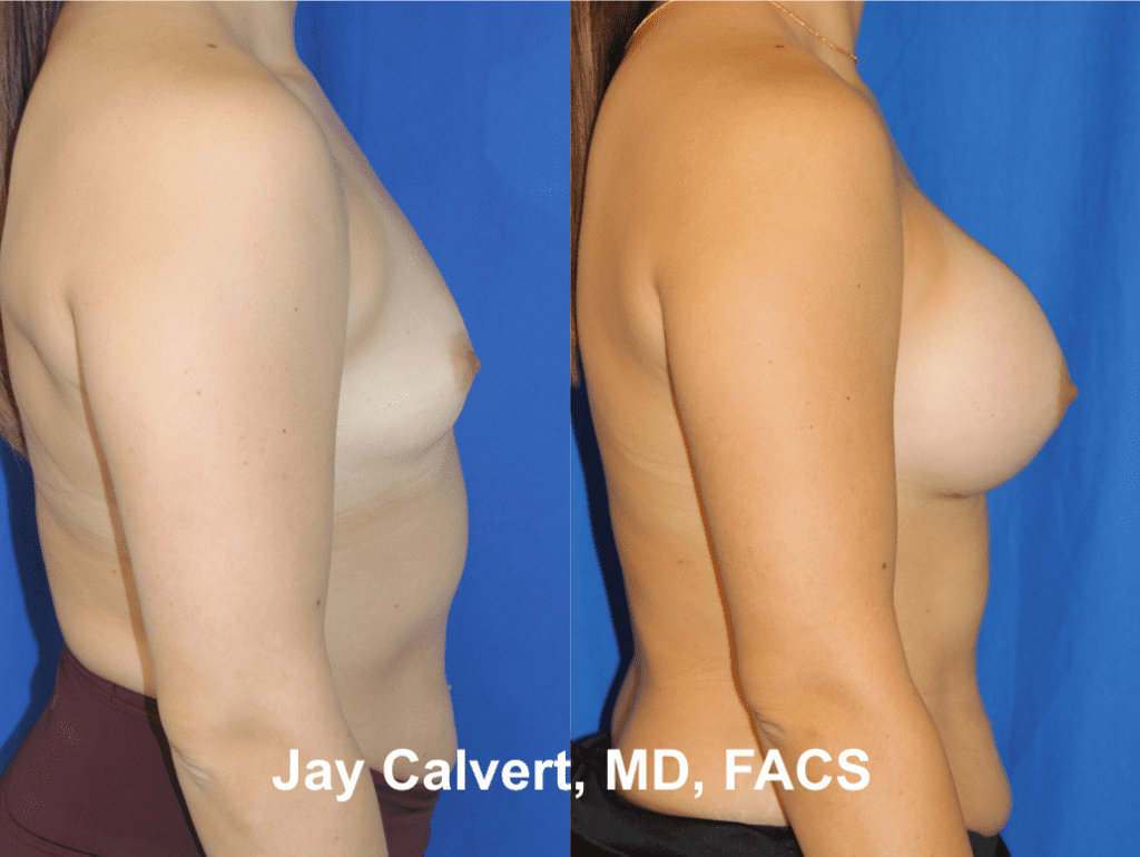 Primary Breast Augmentation by Dr. Jay Calvert 8d