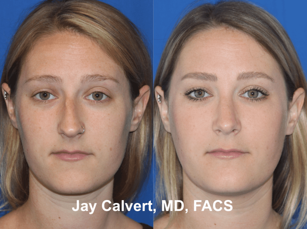 Primary Septorhinoplasty by Dr. Jay Calvert 6t