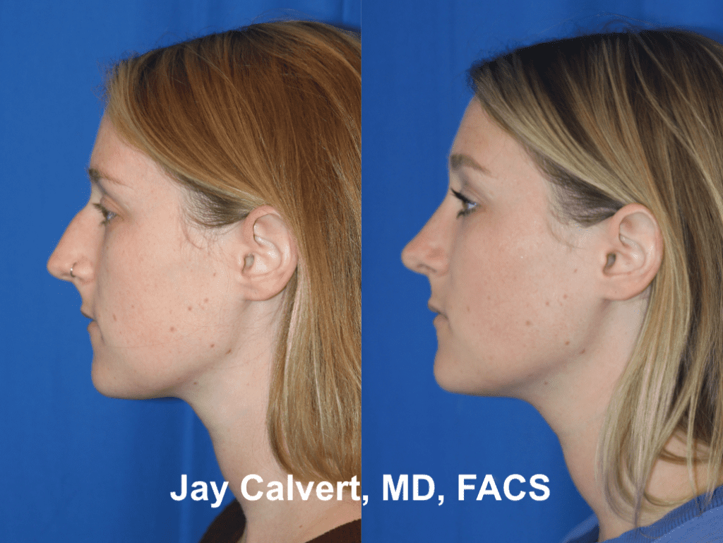 Primary Septorhinoplasty by Dr. Jay Calvert 6b