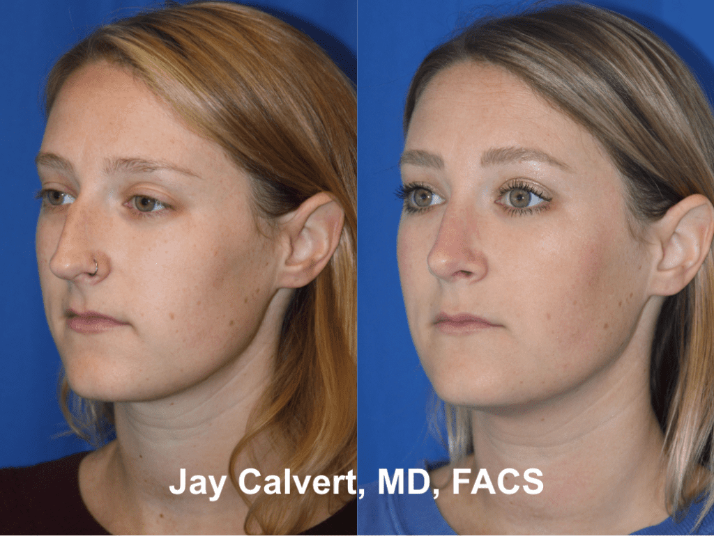 Primary Septorhinoplasty by Dr. Jay Calvert 6a