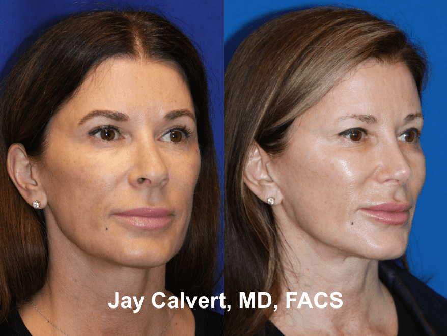 Revision Rhinoplasty by Dr. Jay Calvert 9e