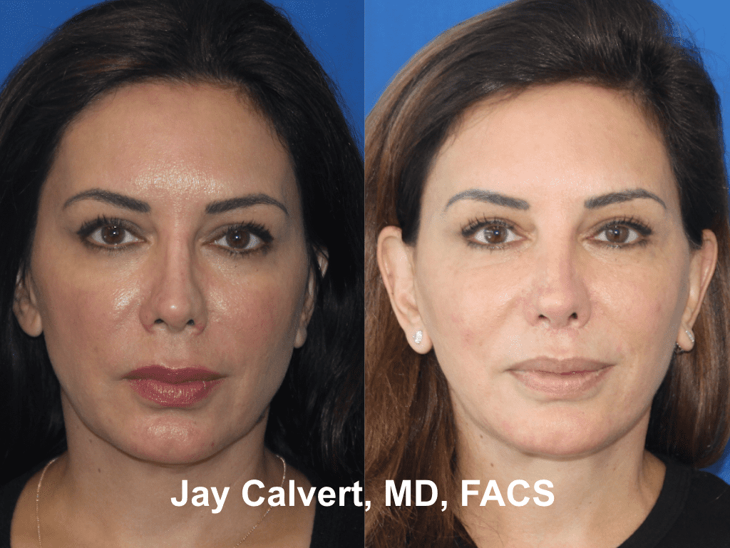 Revision Rhinoplasty by Dr. Jay Calvert 7a