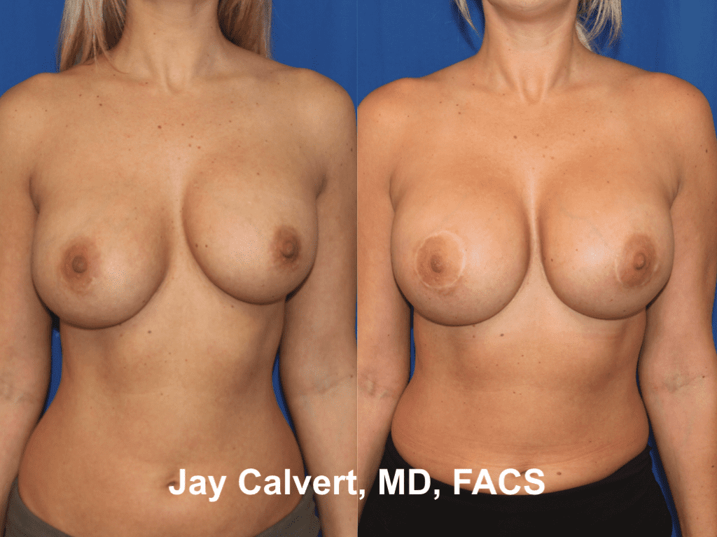 Breast Implant R&R by Dr. Calvert