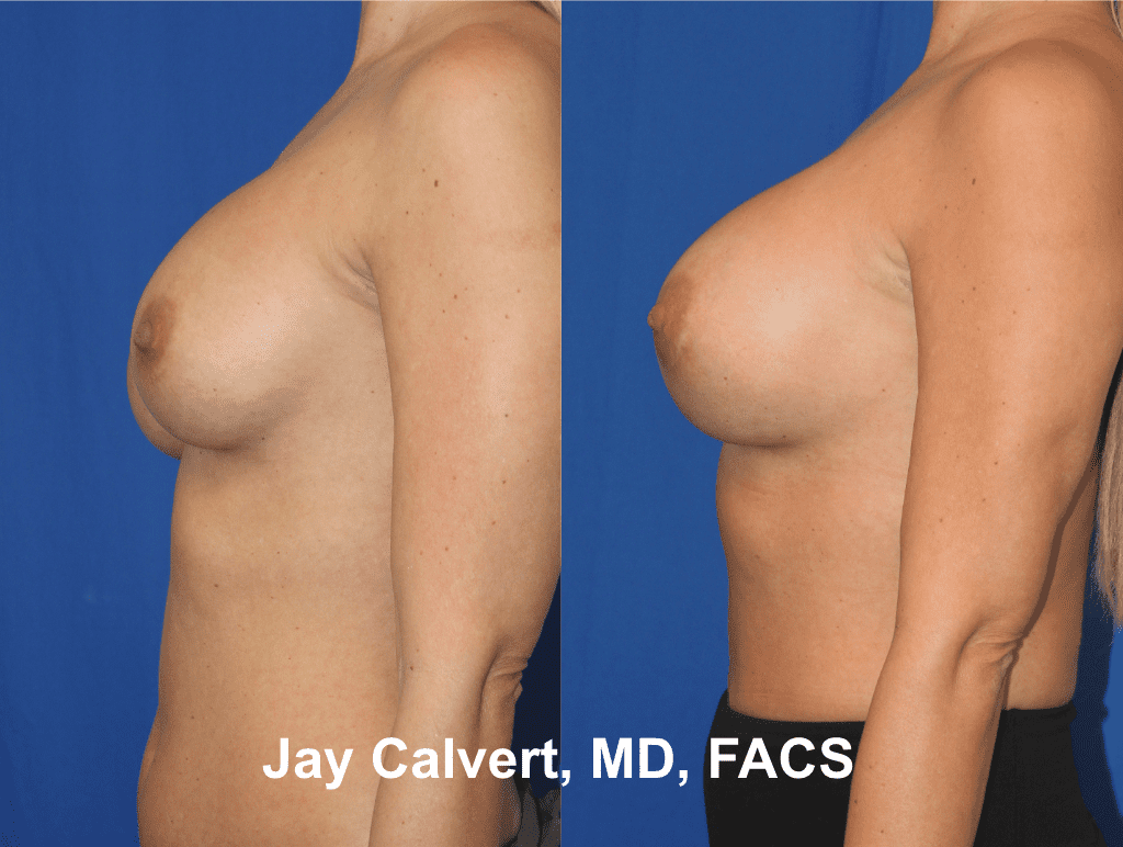 Breast Implant R&R by Dr. Calvert 1a