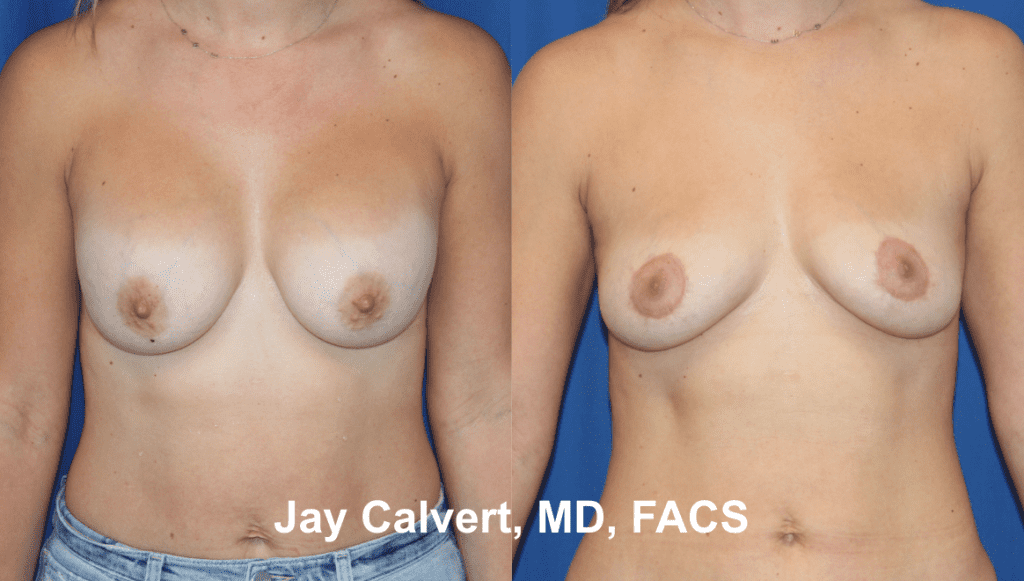 Explantation + Fat Grafting by Dr. Calvert