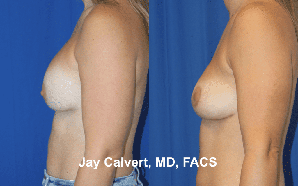 Explantation + Fat Grafting by Dr. Calvert 1a