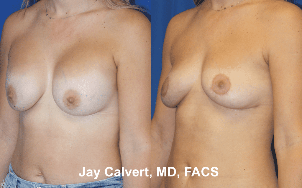 Explantation + Fat Grafting by Dr. Calvert 1b